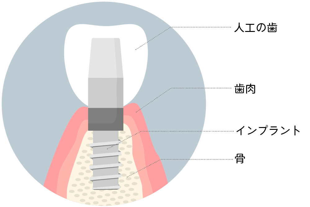 インプラント